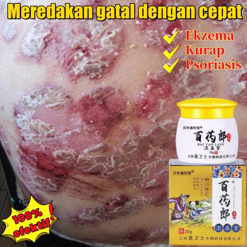 Salap Gatal Kulit Yang Ampuh Salep Eksim Kering Paling Ampuh Obat Jamur Kulit Salep Eksim Kering Pal