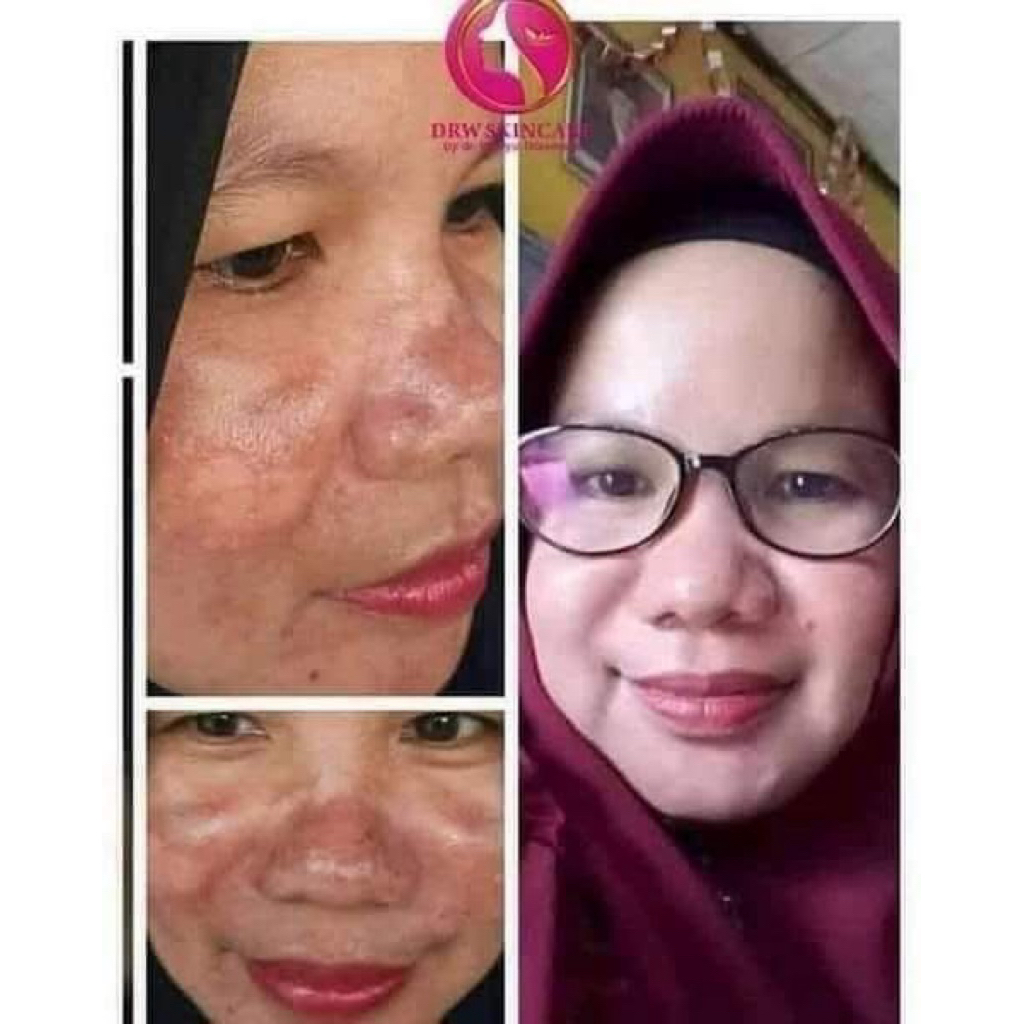 paket flek berat Drw skincare