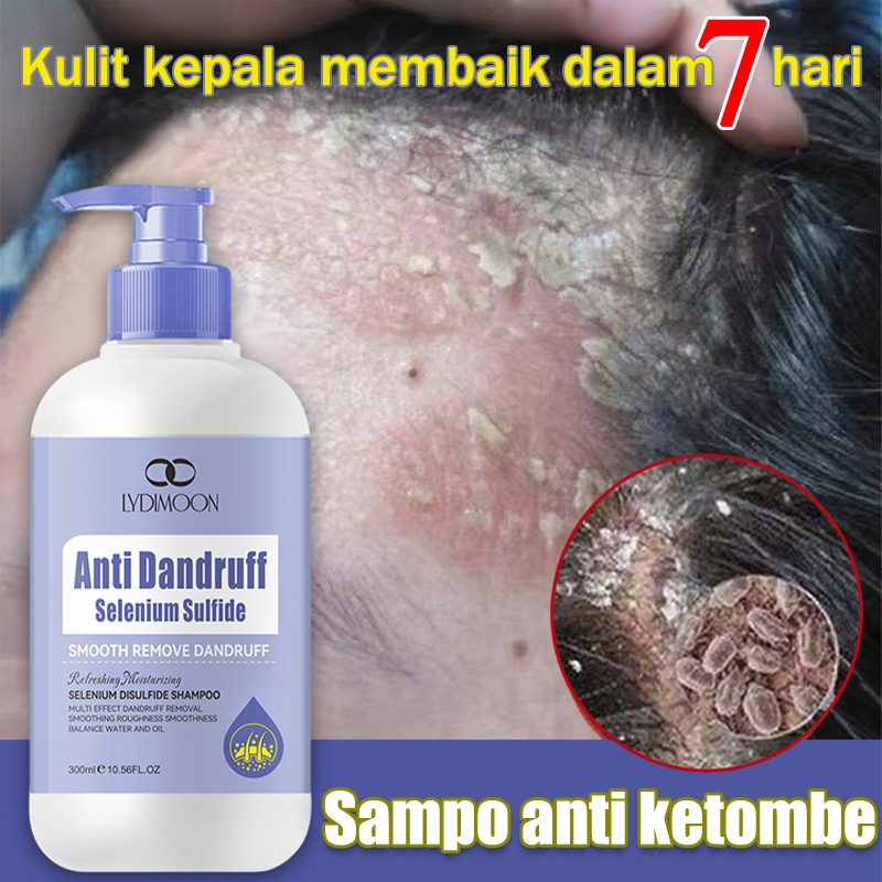 Sampo anti ketombe sampho anti ketombe dan rontok sampo anti gatal and ketombe sampo anti ketombe da