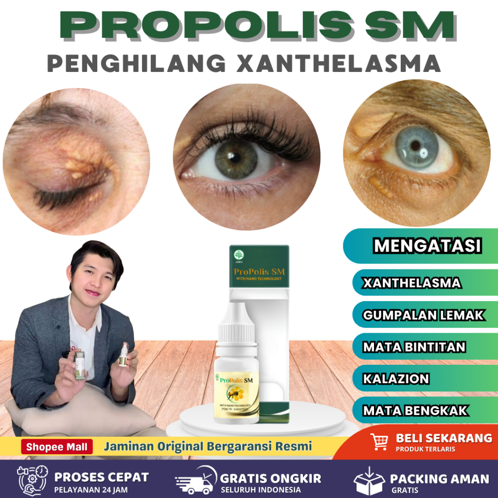 Obat Xanthelasma Syringoma Milia di Bawah Mata | Obat Gumpalan Lemak Di kelopak Mata Propolis SM