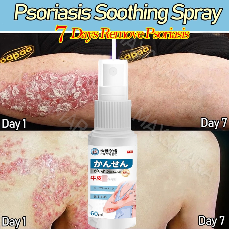 Obat kurap Psoriasis spray spray gatal selangkangan Spray gatal selangkangan dan kelamin Eczema Spra