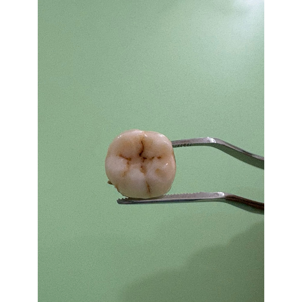 Gigi 46/gigi molar bawah kanan/gigi molar/gigipraktikum/fkg/gigiasli/gigi/kedokteran gigi