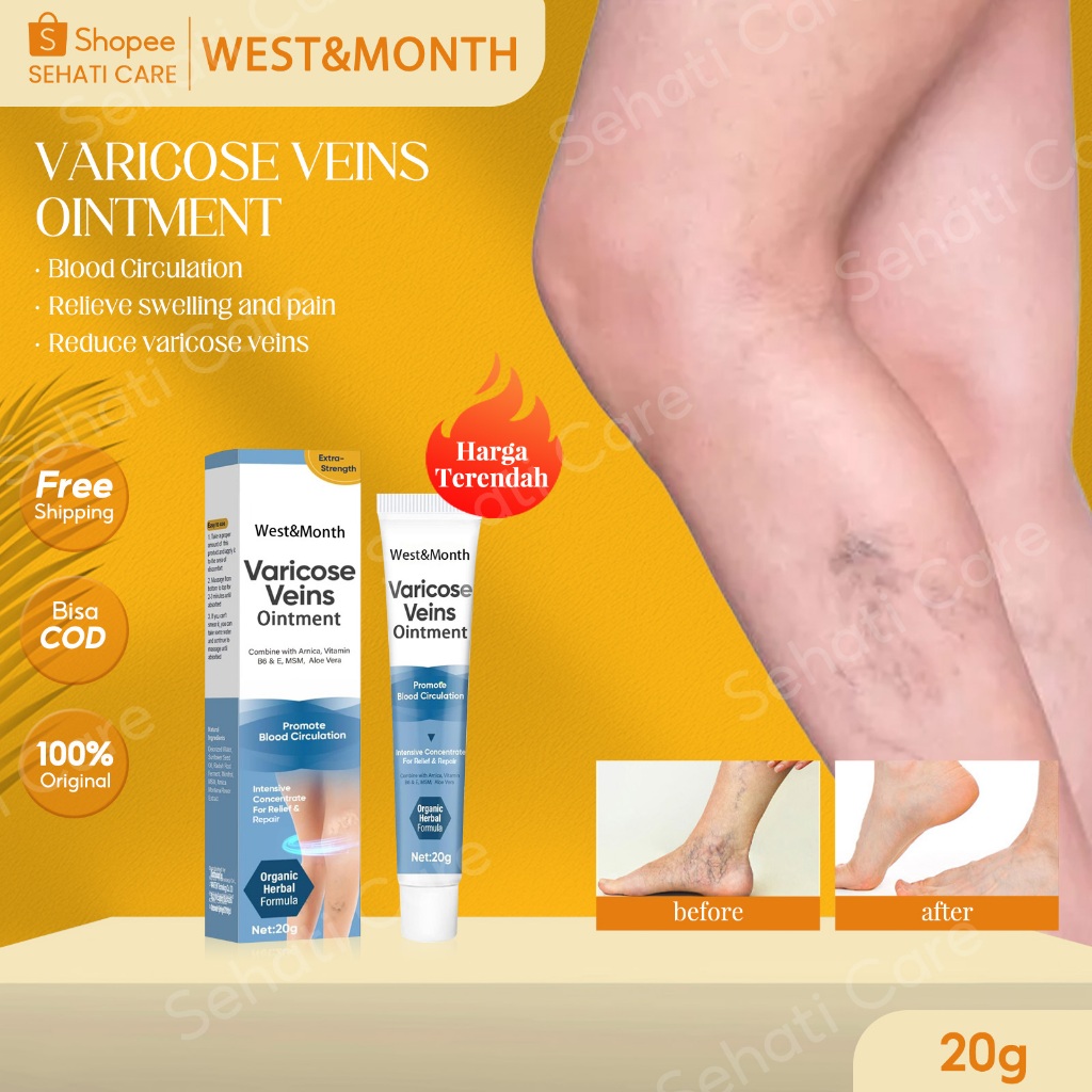 West&Month Varicose Veins Ointment 20g Obat Salep Varises Lmprove Blood Circulation Relieve Swelling