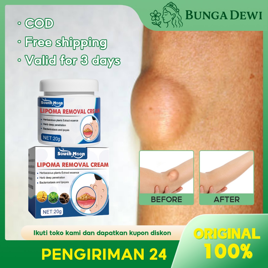 South Month Lipoma Cream Original 50g Lipoma Removal Cream 100% Original Herbal Salep Lipoma Salep B