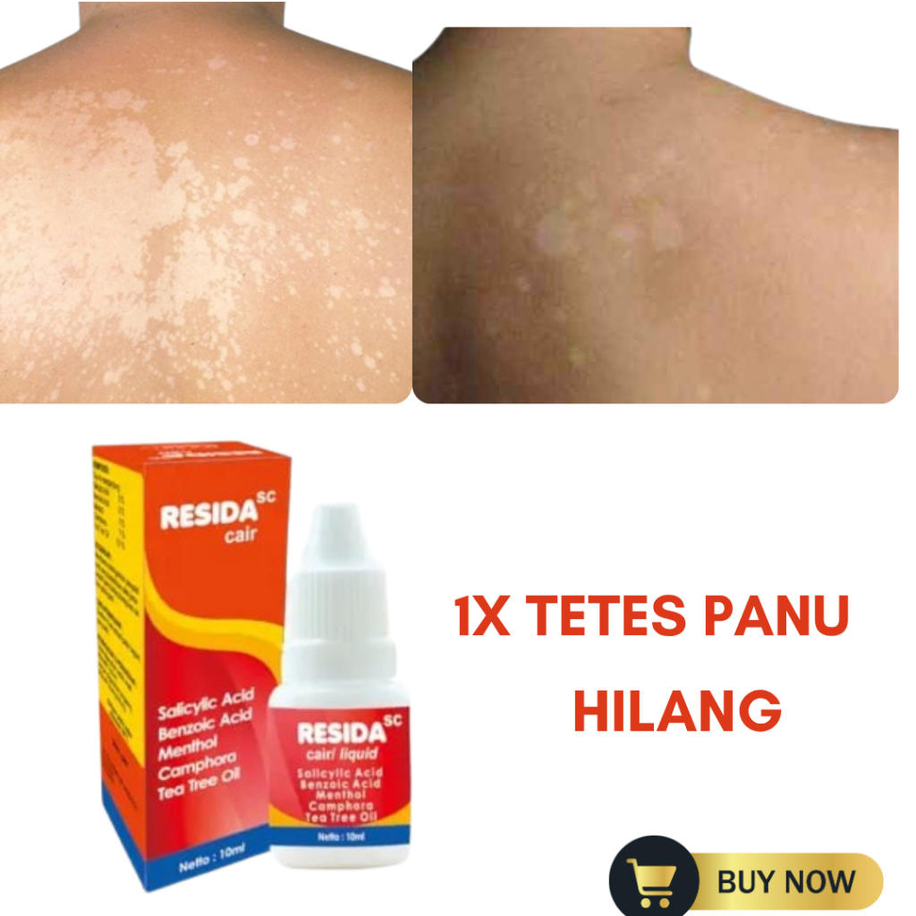 Obat Panu Cair Paling Ampuh 100% Obat Panu Cair Resida Original BPOM Penghilang Gatal Jamur Kadas Ku