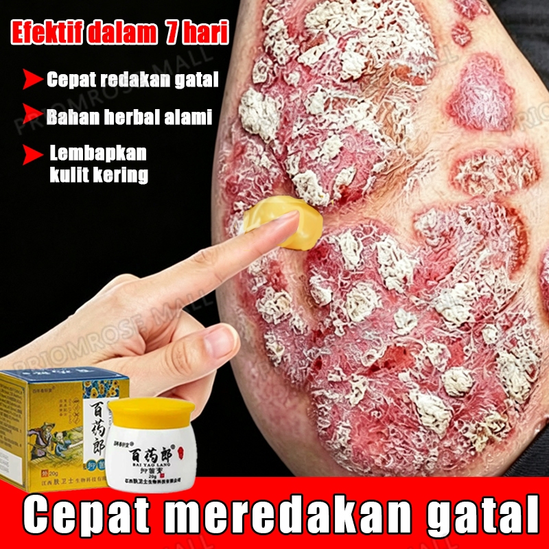Salep gatal china paling ampuh salep eksim kering dan gatal original obat gatal selangkangan salep g