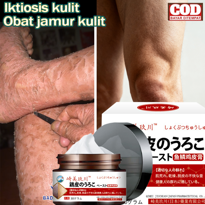 Obat gatal kulit Salep eksim Iktiosis Iktiosis kulit Obat jamur kulit Salep kulit 20gKrim kaki pecah