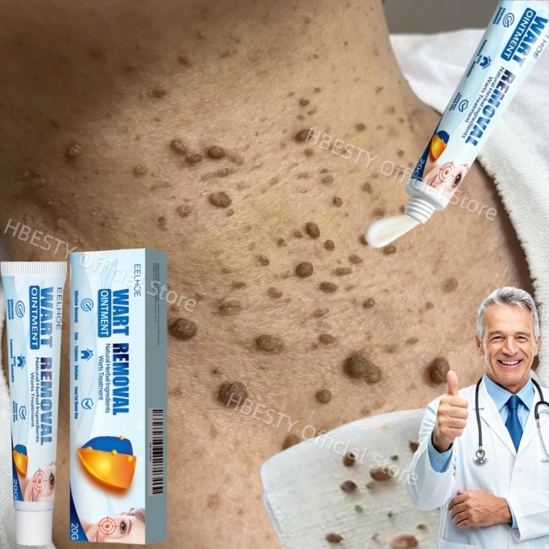 HBESTY Penghilang kutil dan tahi lalat Skin tag remover Krim penghilang kutil di wajah Kutil Remover