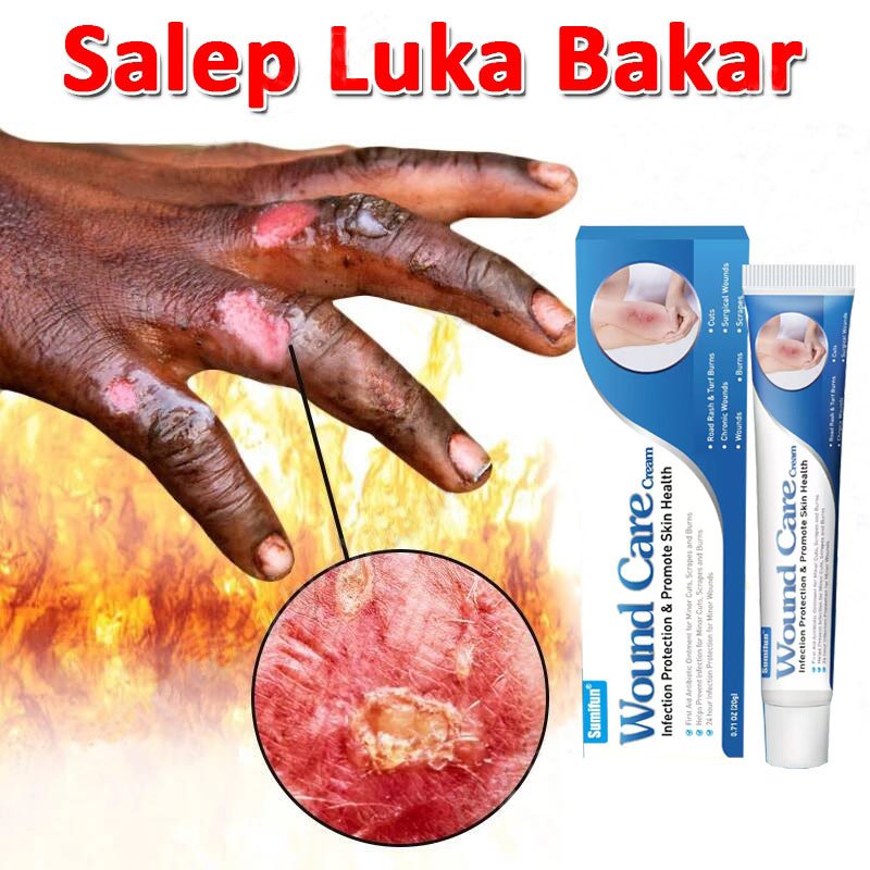 Salep Luka Bakar Paling Ampuh Obat Luka Bakar Salep Bekas Luka Bakar Penghilang Bekas Luka Bakar Men