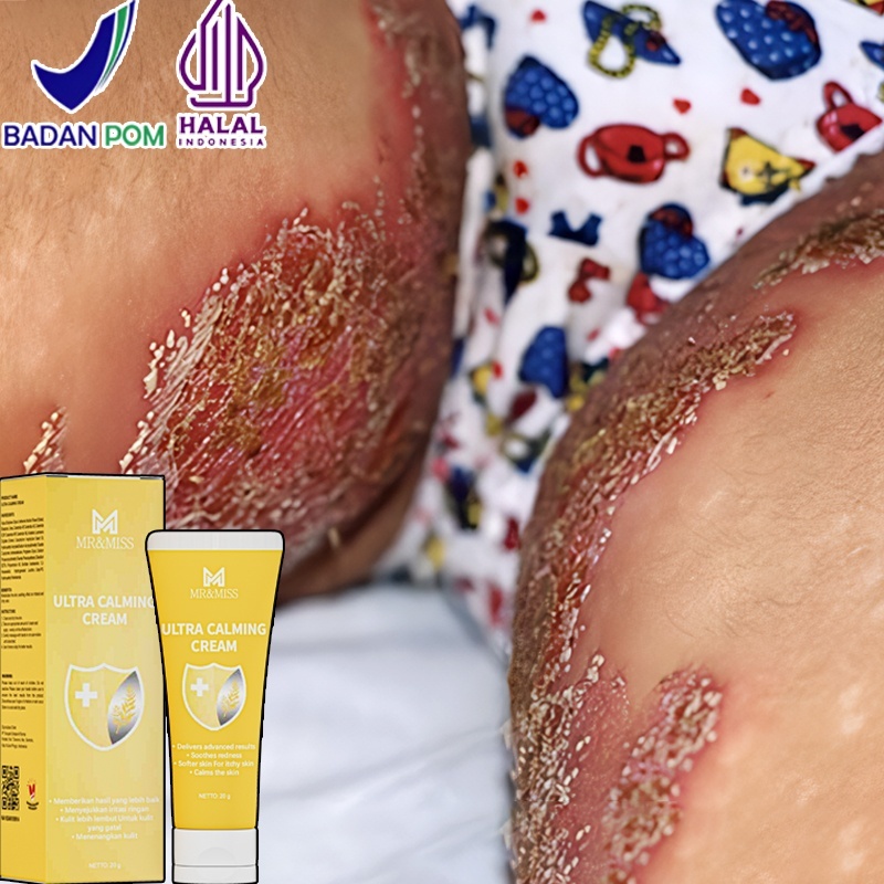 Salep eksim kering dan gatal Salap gatal china 0bat gatal gatal kulit ampuh Salep gatal selangkangan