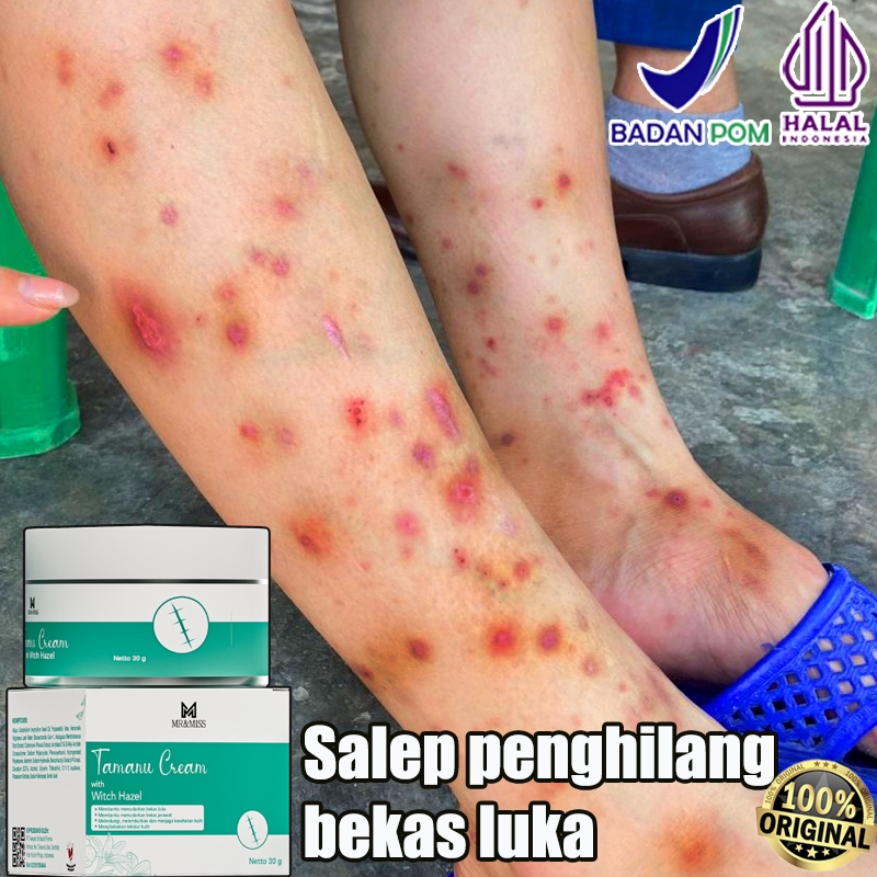 Penghilang bekas luka Cream penghilang bekas luka koreng Penghilang bekas luka anak Penghilang bekas