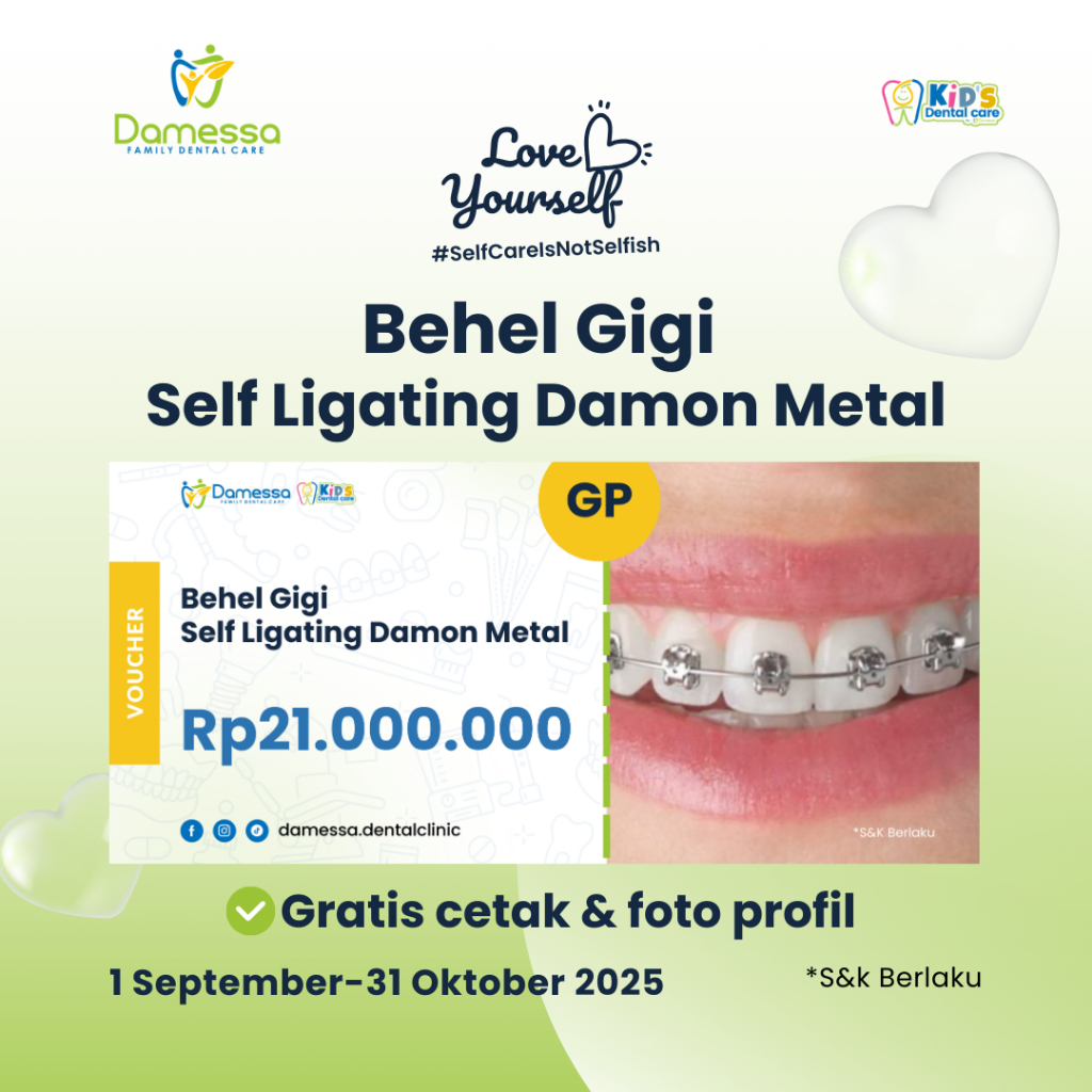 Voucher Behel Gigi Damessa - Pasang Behel Gigi Self Ligating Damon Metal with General Dentist