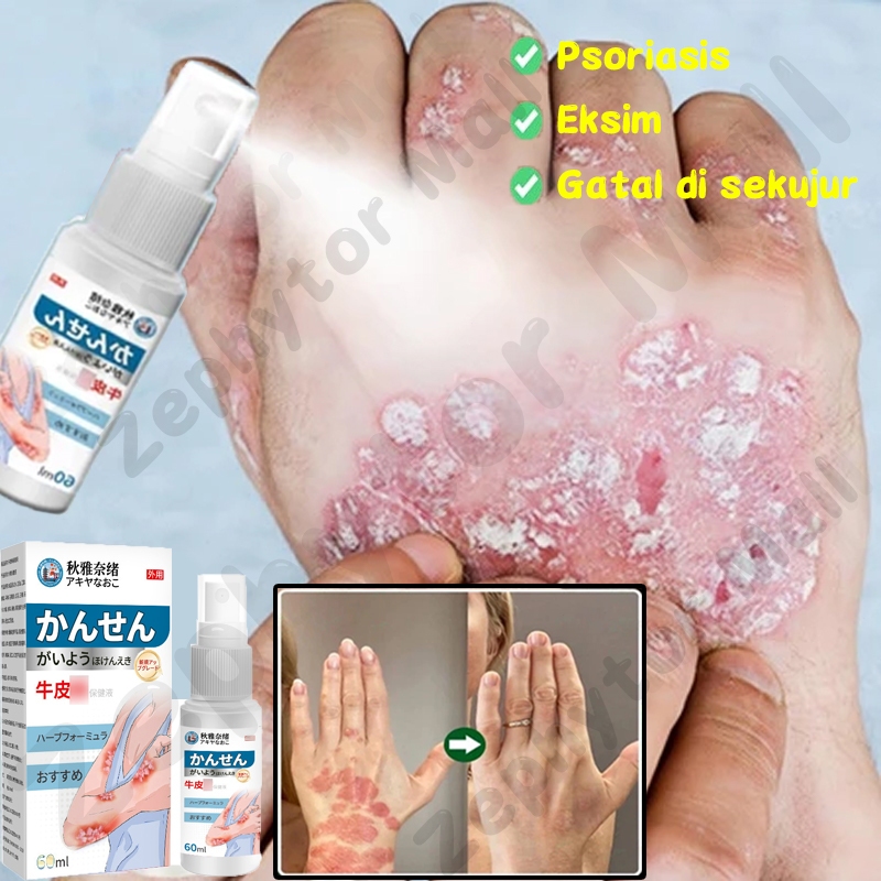 obat gatal kulit obat psoriasis salep eksim kering dan gatal untuk gatal jamur selangkangan penghila