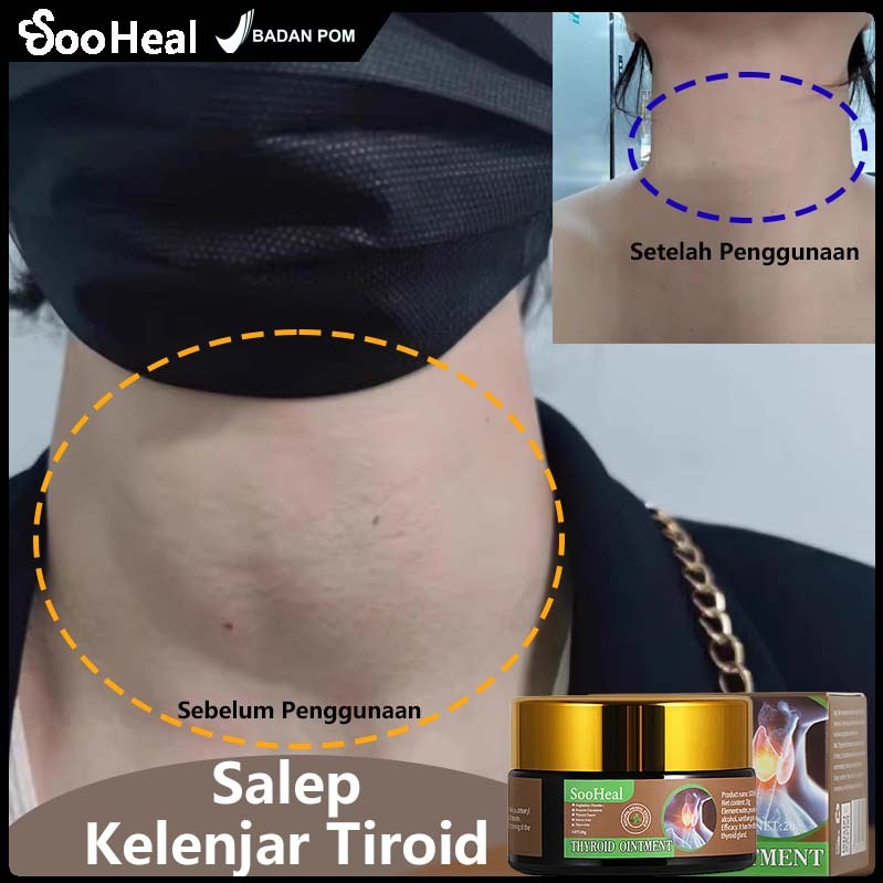 Sooheal Thyroid Ointment Krim Obat Hipertiroid, Hipotiroid, Kelenjar Tiroid Bengkak Obat Gondok Di L