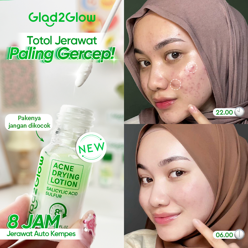GLAD2GLOW Acne Drying Lotion -Jerawat Salicylic Acid Acne Treatment Niacinamide Memudarkan Acne Spot