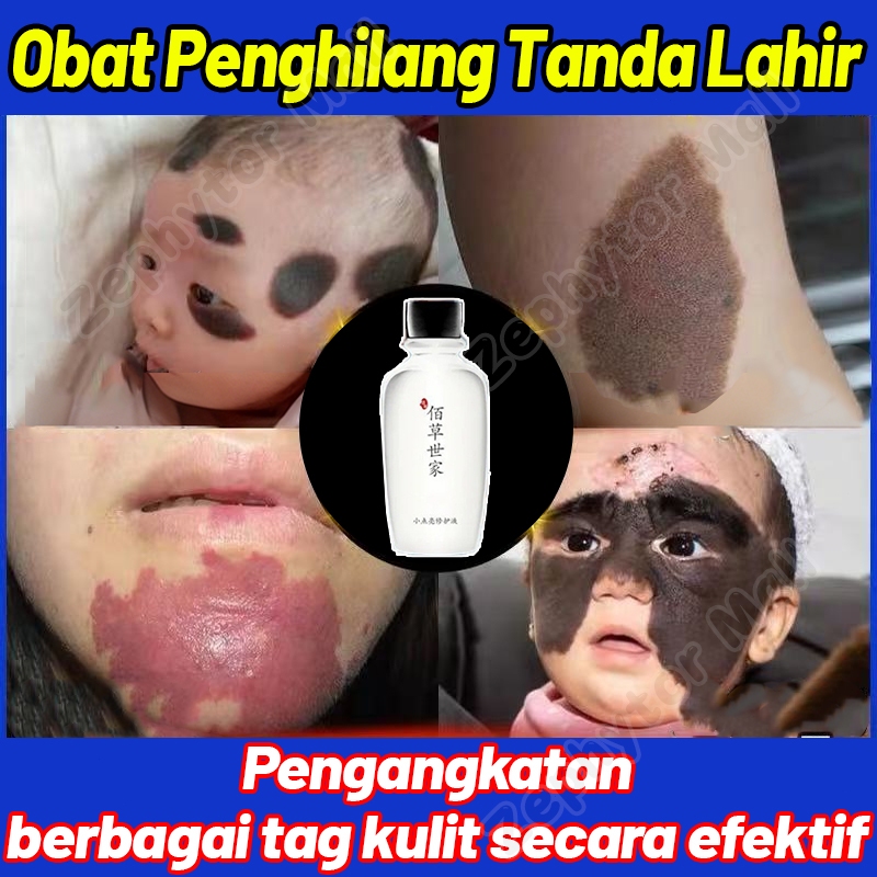 Obat Penghilang Tanda Lahir Obat Penghilang salep penghilang bekas luka hitam  koreng obat penghilan