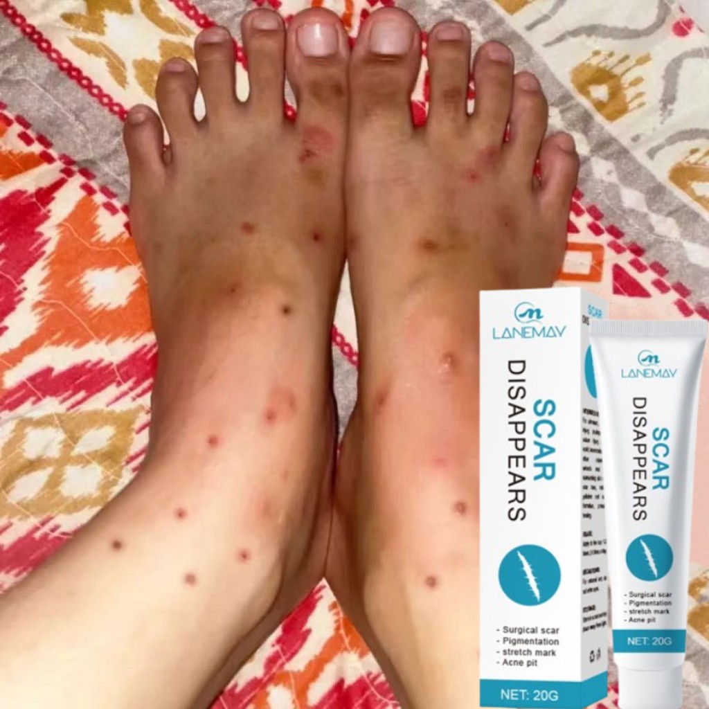 Bekas luka hitam di kaki Cream penghilang bekas luka koreng Salep bekas luka anak Pembersih bekas lu
