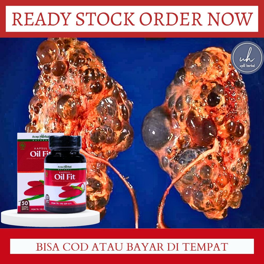 Obat Kista Ginjal, Obat Herbal Penghilang Kista Ginjal, Pencegahan Kista Ginjal, Obat Perawatan Ginj