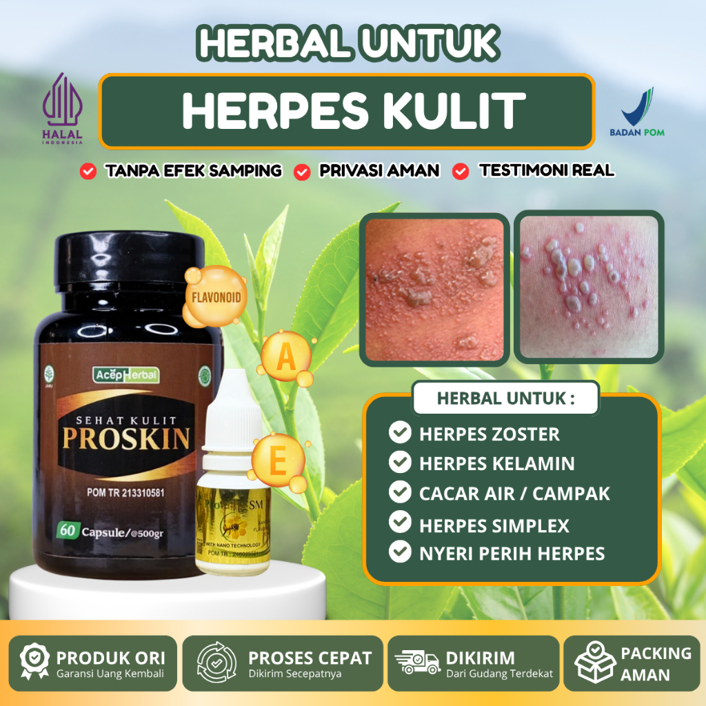 Obat Herpes Zoster, Herpes Kelamin, Herpes Bibir, Herpes Genital Herpes Kulit Herpes Simplex