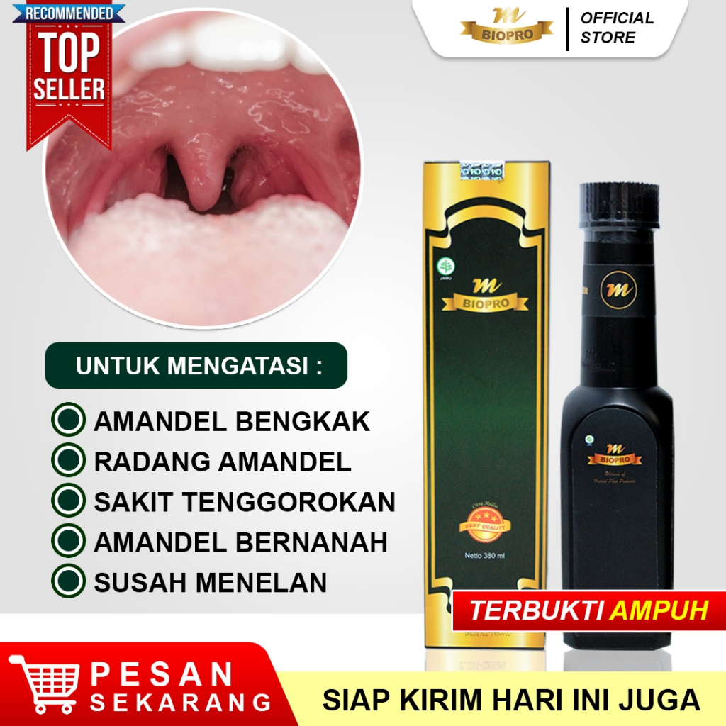 Obat Amandel Tanpa Operasi, Amandel Tanpa Operasi Untuk Anak Dan Dewasa, Radang Tenggorokan, Radang 