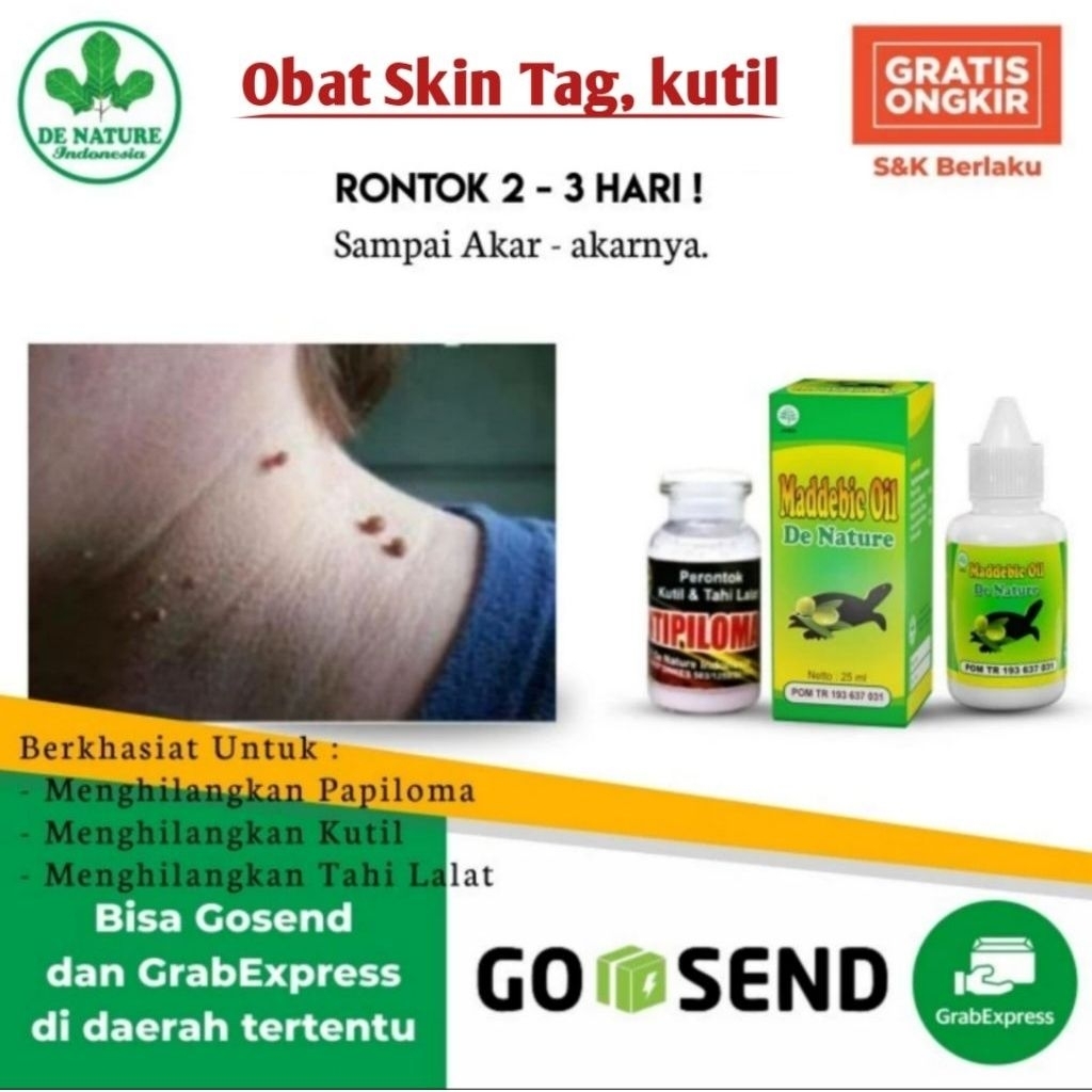 Obat Skin Tag & Obat Kutil Kelamin De Nature Original | Salep Remover Penghilang Daging Tumbuh Papil
