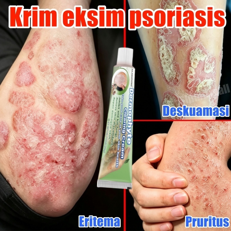 Psoriasis cream Salep eksim kering paling ampuh Obat eksim kulit Salep dermatitis seboroik gatal eks