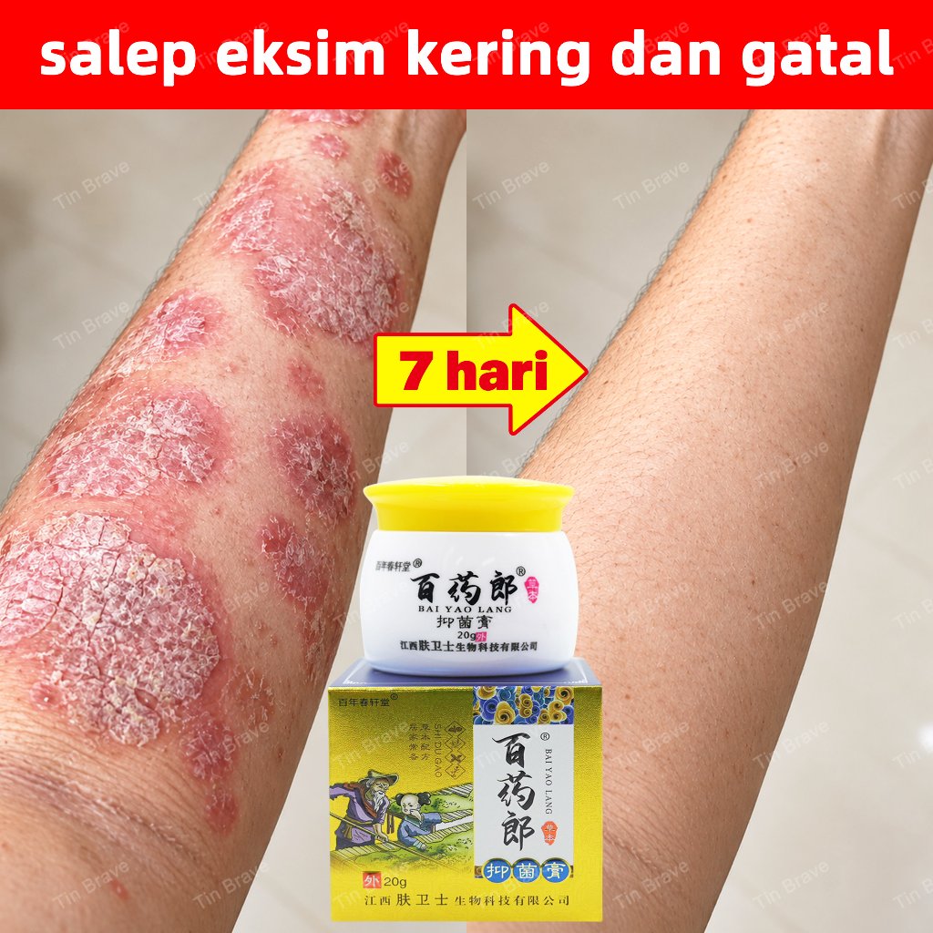 salep gatal china salep eksim kering dan gatal paling ampuh Psoriasis Cream salep gatal selangkangan