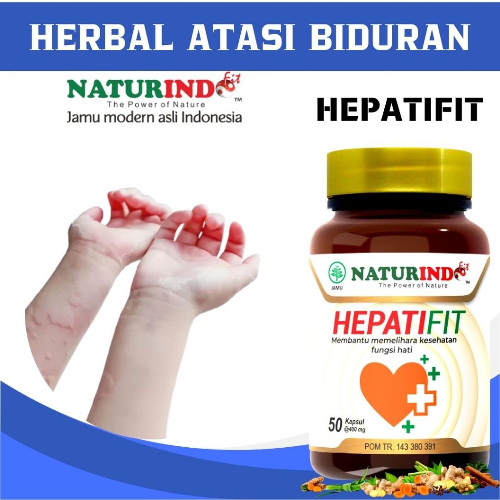 Obat Gatal Kulit Alergi Dingin Biduran Gatal Alergi Herbal Bentol Kulit, Obat Biduran Kronis, Alergi