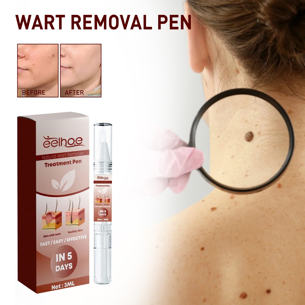 EELHOE Wart Remover Pen 3ml Krim Penghilang Kutil Penghilang Kutil Dan Tahi Lalat Yang Efektif Pengh