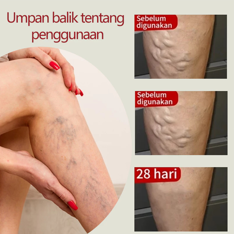 100% Asli Obat Varises Asli 20g Salep Penghilang Varises Ampuh Obat Varises Original Obat Varises Di