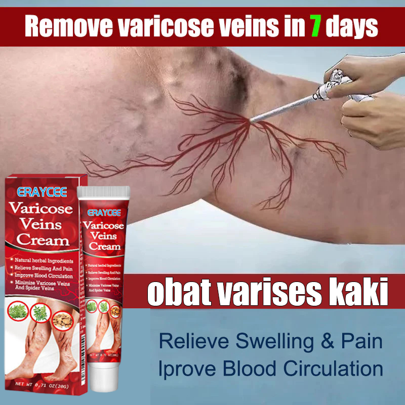 south moon [AMPUH 100%]Obat Varises Original 20g, Varises & Vaskulitis Hilang Permanen, Cepat Sembuh