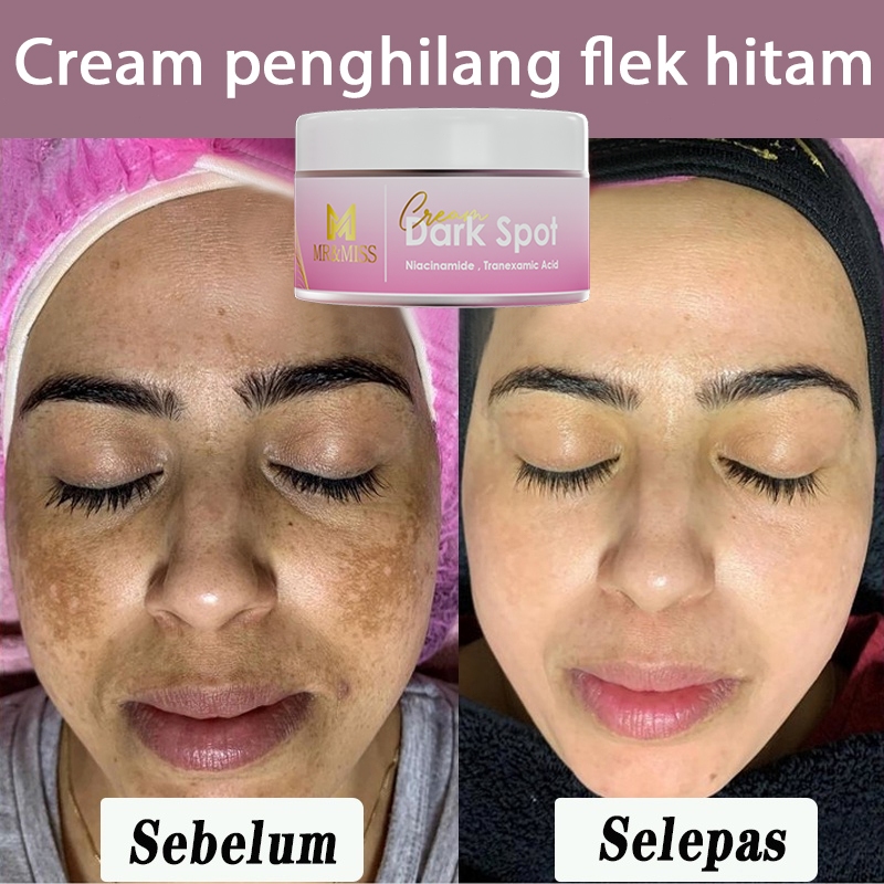 Cream penghilang flek hitam salep flek hitam membandel krim flek hitam membandel bpom ori 30g salep 