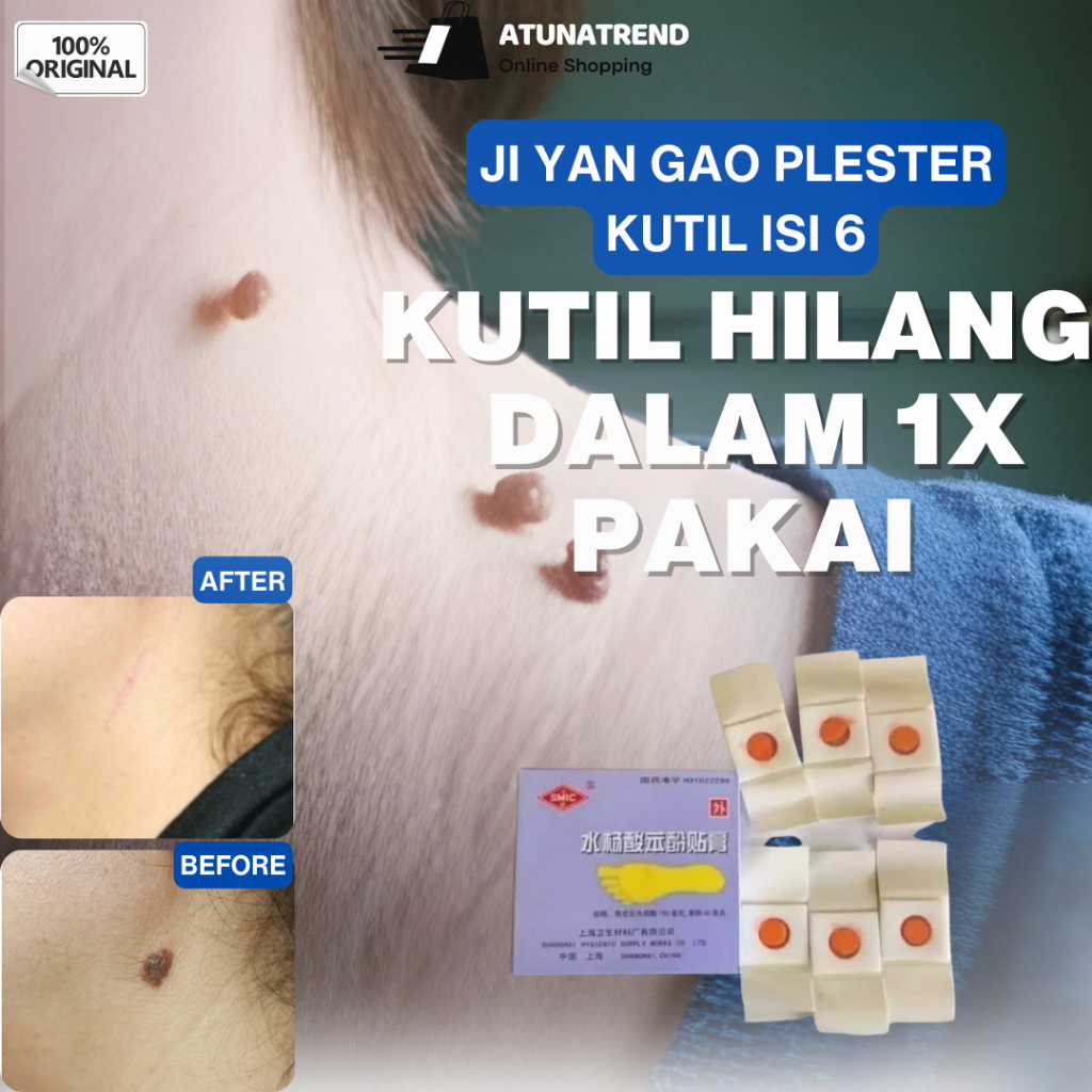 Obat Plester Kutil Mata Ikan Kapalan Paling Ampuh untuk Tangan dan Kaki Tanpa Operasi
