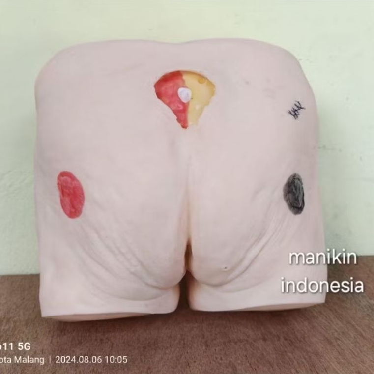 ULKUS DEKUBITUS|BOKONG/ PANTAT DECUBITUS SIMULATORĮLUKA BARING/BEDSORES