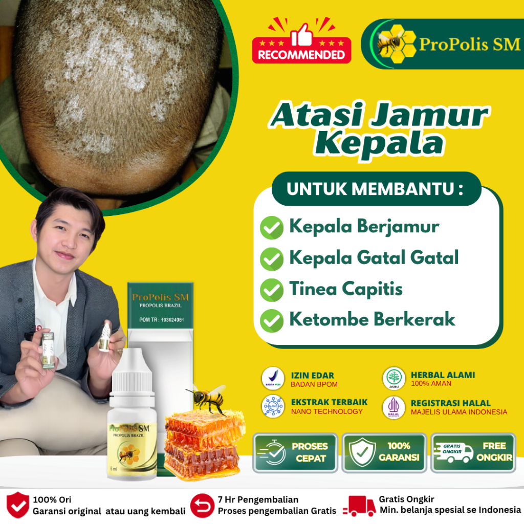 Obat Kurap Jamur di kulit Kepala, Kulit Kepala Berjamur, Kulit Kepala Gatal Berjamur, Obat Kepala Bo