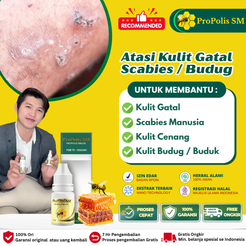 Propolis SM Obat Obat Kulit Gatal Gatal, Obat Kulit Budug, Obat Budug/Buduk, Obat Cenang Bernanah, O