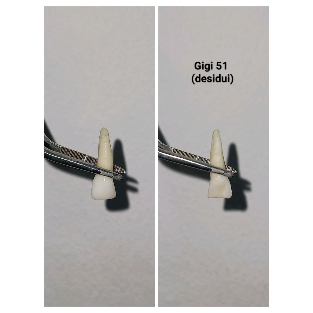 [Gigi 51] Gigi Insisivus Desidui Asli / Gigi Sulung Anterior / Gigi Insisivus Pedo / Gigi Praktikum 