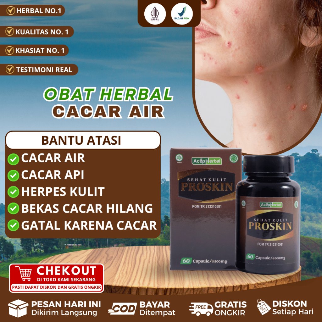 Obat Cacar Air, Obat Cacar Api, Obat Penghilang Bekas Cacar, Obat Herpes Kulit, Obat Cacar Monyet, O