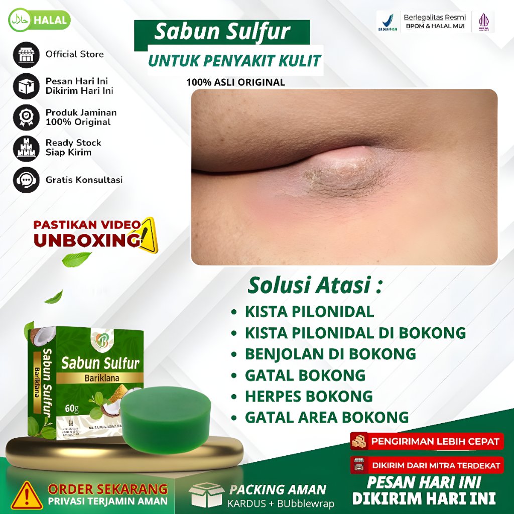 Sabun Sulfur Bariklana - Atasi Kista Pilonidal, Kista Pilonidal Di Bokong, Benjolan Di Bokong, Gatal
