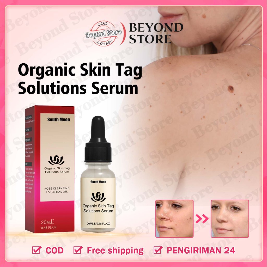 Penghilang Tahi Lalat Penghilang Kutil Obat Penghilang Tahi Lalat Skin Tag Remover Tahi Lalat Menghi