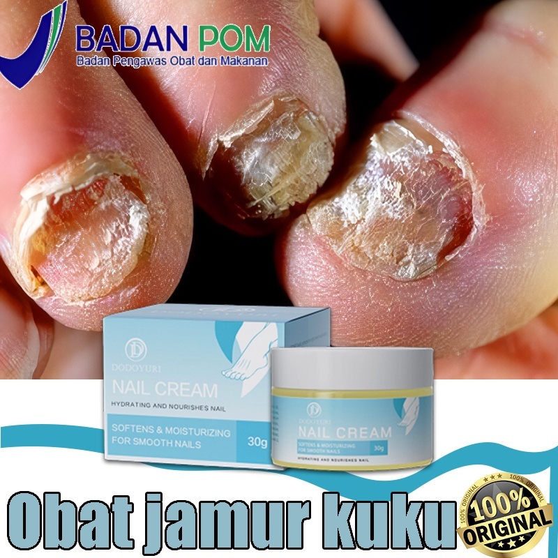 Obat jamur kuku Obat kuku Obat cantengan Obat kuku rusak dan jamur 30g obat cantengan jempol kaki ku