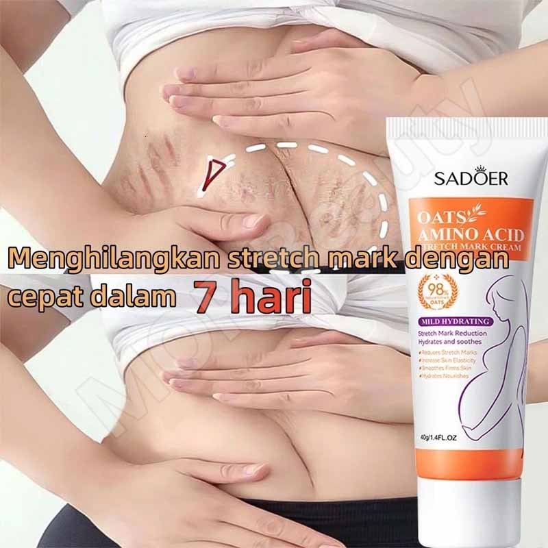 penghilang strechmark stretch mark stretch mark cream strechmark setelah melahirkan menghilangkan st