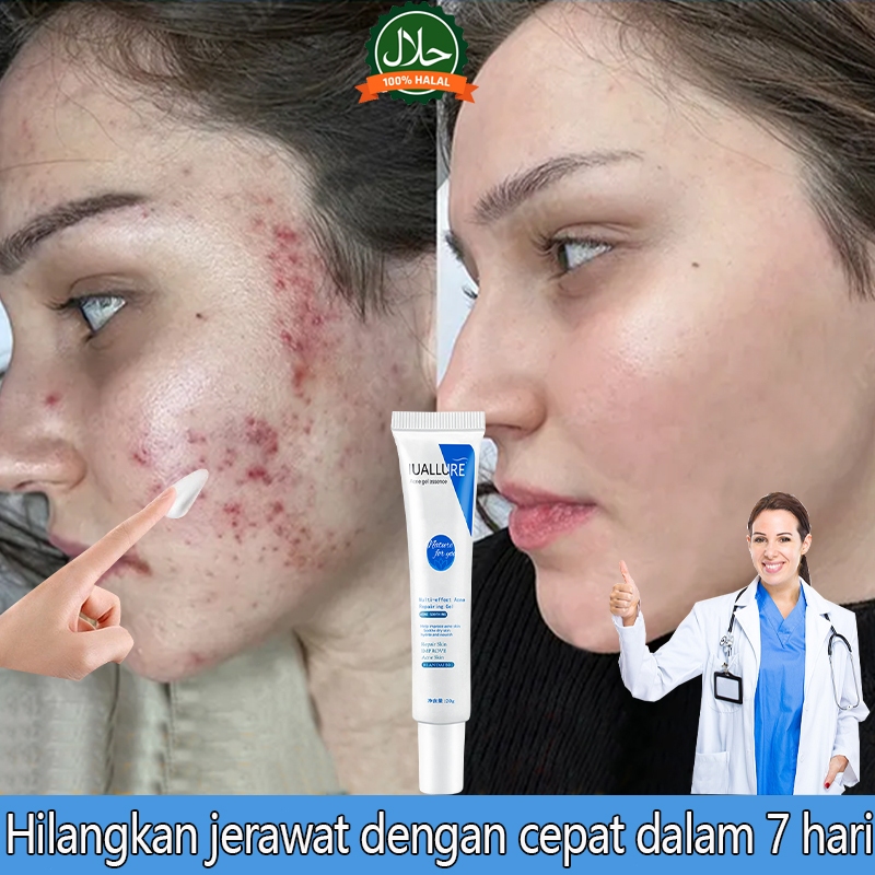 IUALLURE Acne Cream salep Jerawat dan bekas Removal cream  Obat jerawat Gel Bekas jerawat Lotion Acn