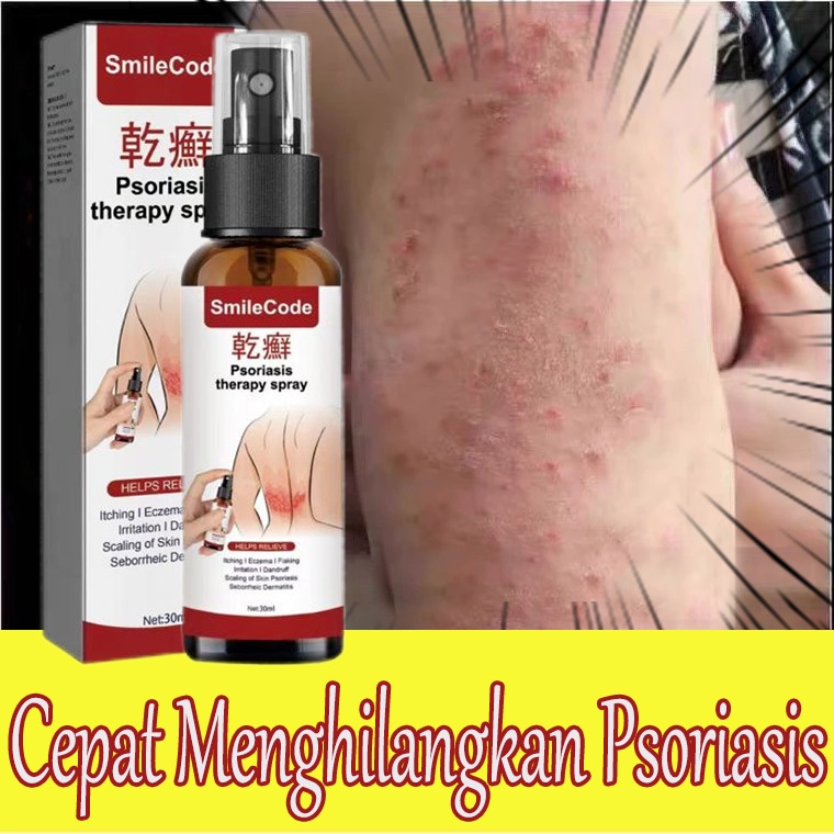 Obat gatal kulit Obat gatal gatal seluruh badan Cream gatal Obat gatal eksim Krim penghilang gatal -