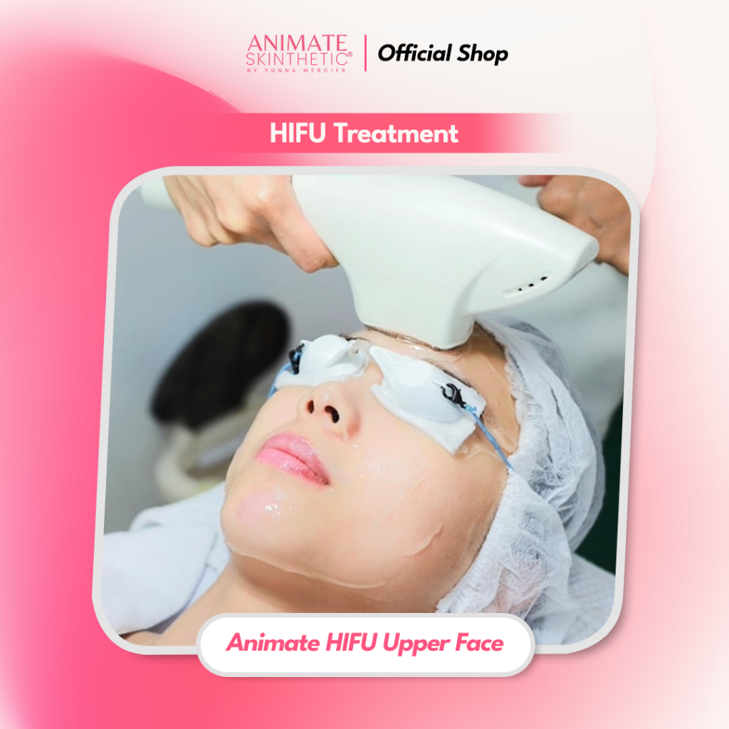 Animate HIFU - Upper Face