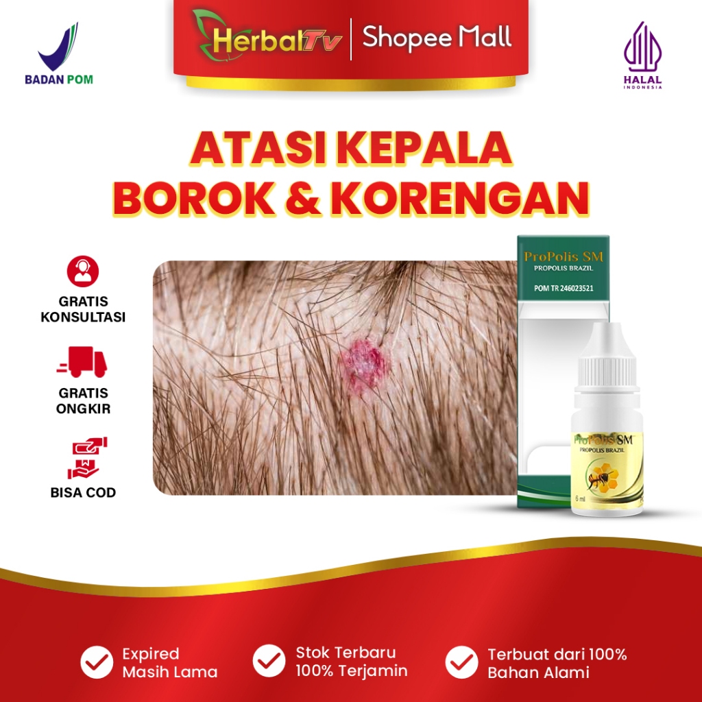 Propolis SM - Obat Tetes Kepala Borok, Kepala Korengan, Kepala Bernanah, Obat Kepala Borok Untuk Ana