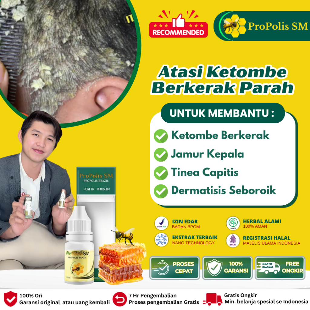 OBAT KETOMBE - PENGHILANG KETOMBE - OBAT KETOMBE BERKERAK - OBAT KETOMBE RAMBUT - PENGHILANG KETOBE 