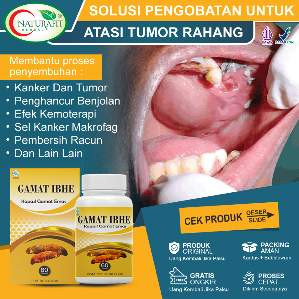 Obat Tumor Rahang Paling Ampuh kanker Rahang Mulut Benjolan Gusi Rahang Bengkak Karsinoma Sel Skuamo