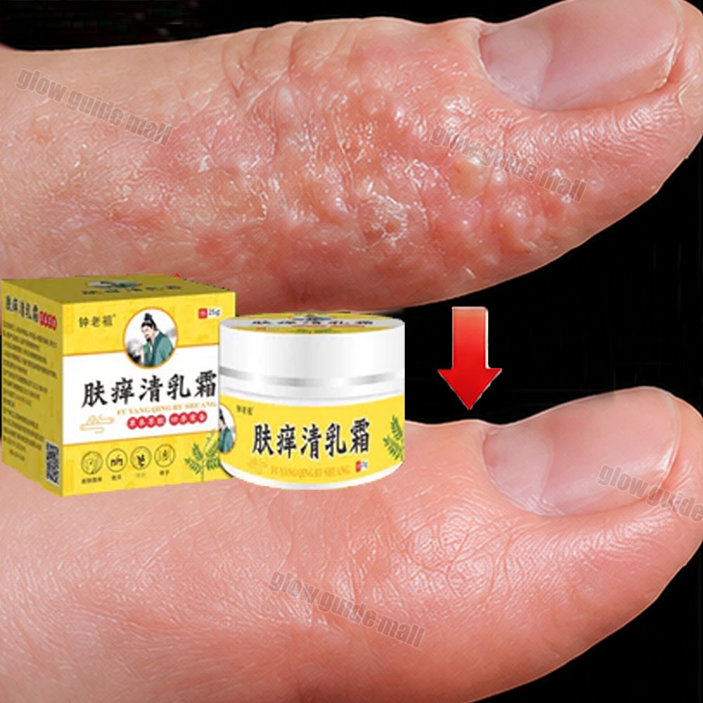 salap gatal china salep eksim kering dan gatal obat psoriasis Menghilangkan Kurap dan Jamur