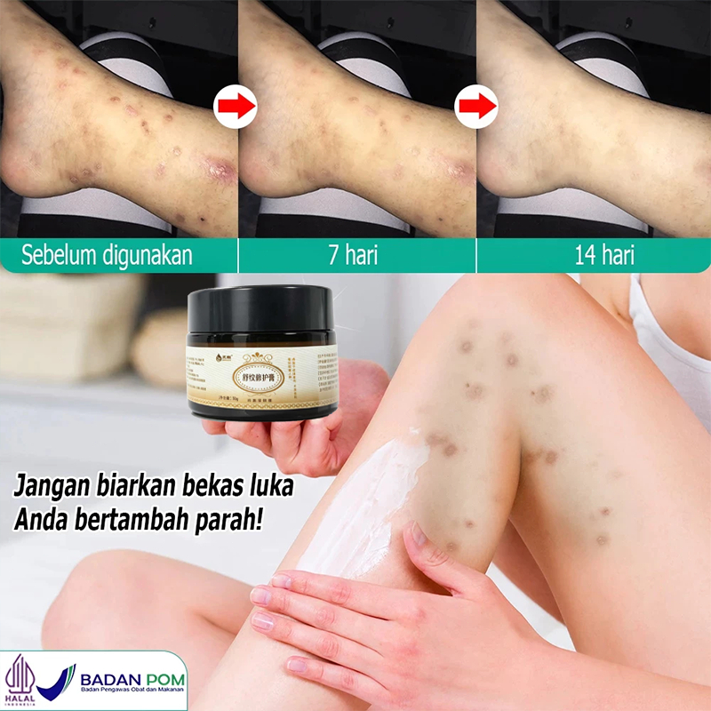 Penghilang bekas luka 30g Penghilang luka koreng bekas gatal gatal Penghilangbekas luka hitam koreng